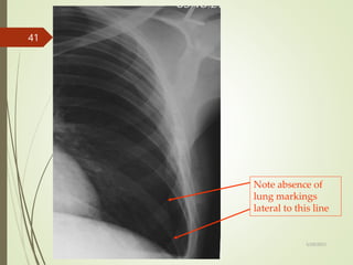 Note absence of
lung markings
lateral to this line
5/29/2023
41
 