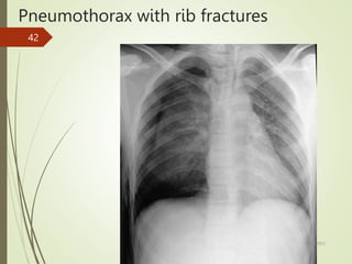 Pneumothorax with rib fractures
5/29/2023
42
 