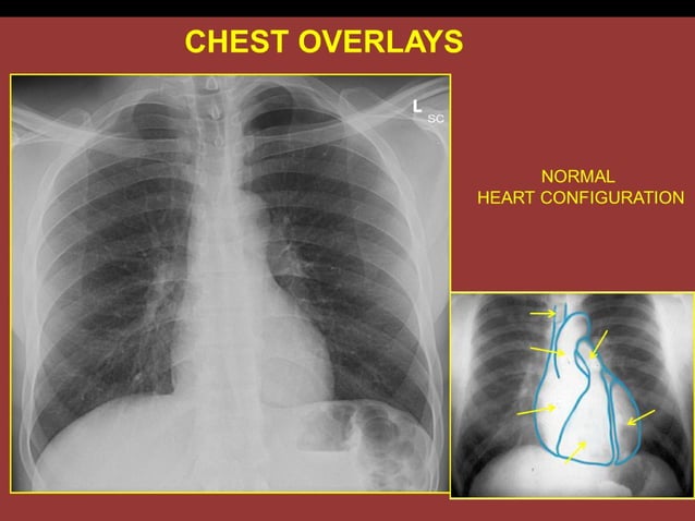 Chest overlays for web ss and unknowns 2012 | PPT