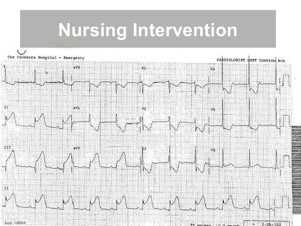 Chest pain nursing assessment and management