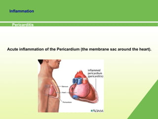 Acute inflammation of the Pericardium (the membrane sac around the heart).  Pericarditis   Inflammation 