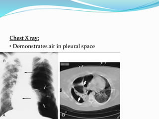 Chest X ray:
• Demonstrates air in pleural space
 
