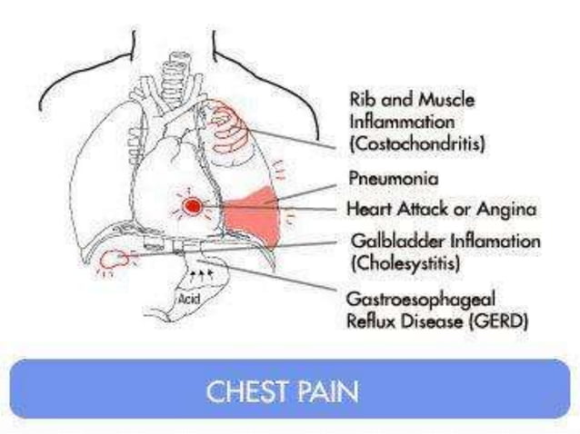 Chest Pain Differential Diagnosis PPT ken-d-berry-md-is-that-pain-in-your-chest-a-big-deal-or