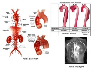 Aortic aneurysm
Aortic dissection
 