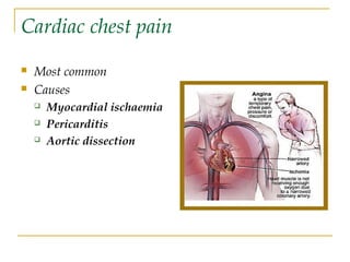 Cardiac chest pain
 Most common
 Causes
 Myocardial ischaemia
 Pericarditis
 Aortic dissection
 