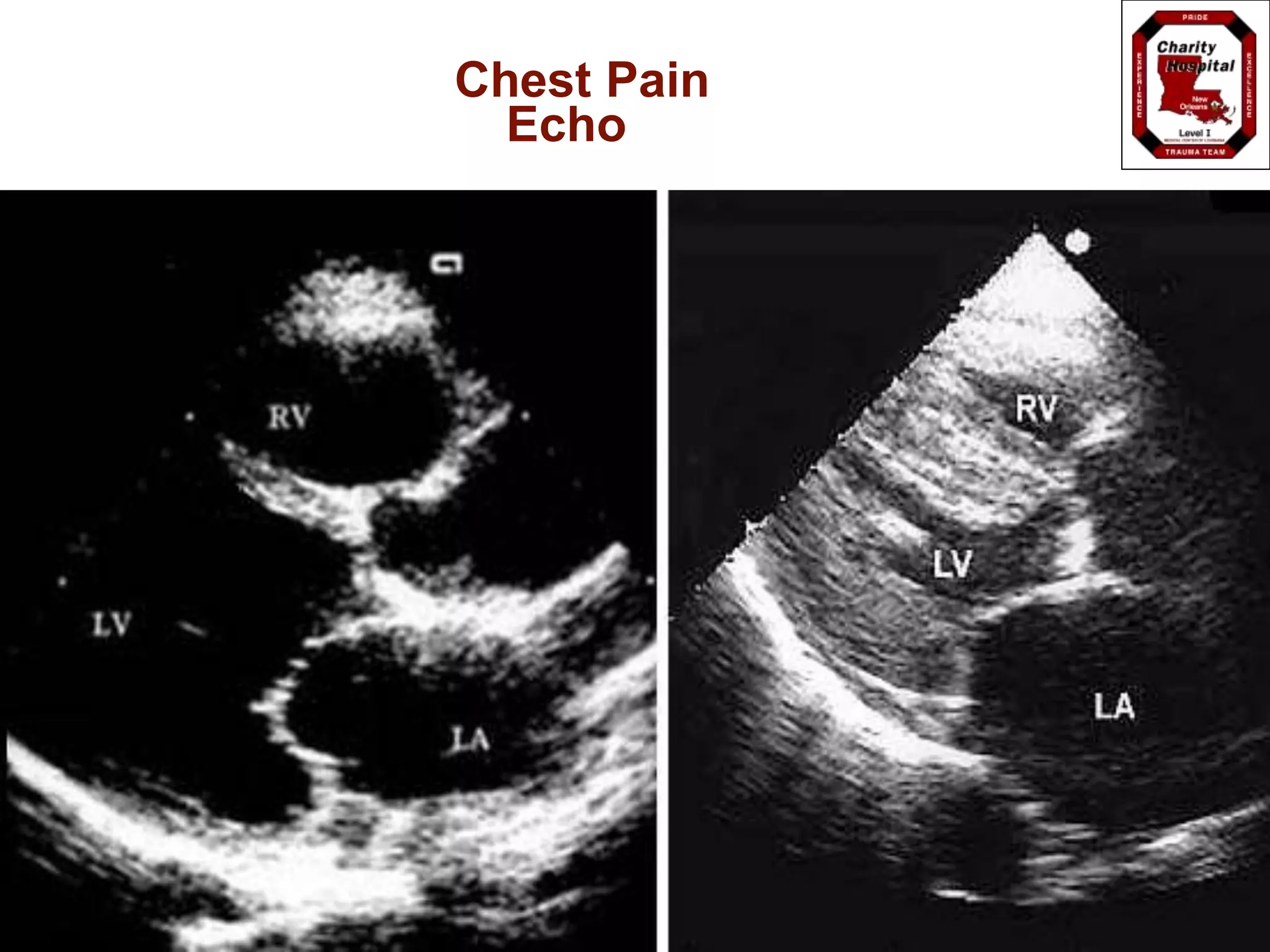 Chest Pain
Echo
 