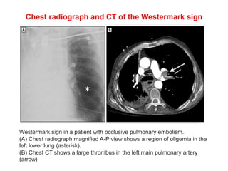 Watermark Sign Radiology APPROACH TO CHEST PAIN.pptx