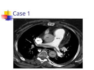 chest pain. Emergency department appraoch | PPT