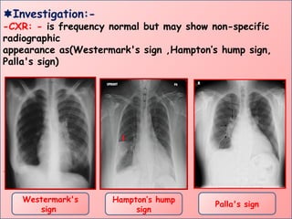 Investigation:-
-CXR: - is frequency normal but may show non-specific
radiographic
appearance as(Westermark's sign ,Hampton’s hump sign,
Palla's sign)
.
Westermark's
sign
Palla's sign
Hampton’s hump
sign
 