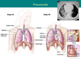 Pneumonitis 
