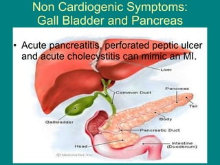 Non Cardiogenic Symptoms: Gall Bladder and Pancreas Acute pancreatitis, perforated peptic ulcer and acute cholecystitis can mimic an MI. 