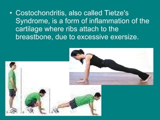 Costochondritis, also called Tietze's Syndrome, is a form of inflammation of the cartilage where ribs attach to the breastbone, due to excessive exersize. 