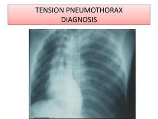 Case 2Respiratory  causeA  30 years  old  patient  presented  with  sudden  onset  right   sided  chest  pain  not  radiates  to  the  any  other  sites  Predisposing  factors ?Fever  ? types  of  chest  pain ?Other  associated  symptoms ? Auscultatory  findingsBreath  soundsClinical  diagnosis  ?investigation