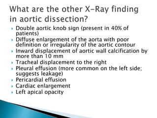  Double aortic knob sign (present in 40% of 
patients) 
 Diffuse enlargement of the aorta with poor 
definition or irregularity of the aortic contour 
 Inward displacement of aortic wall calcification by 
more than 10 mm 
 Tracheal displacement to the right 
 Pleural effusion (more common on the left side; 
suggests leakage) 
 Pericardial effusion 
 Cardiac enlargement 
 Left apical opacity 
 
