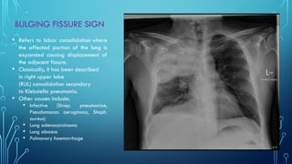 Chest xray pattern Part 1 Year 2 Class.pptx