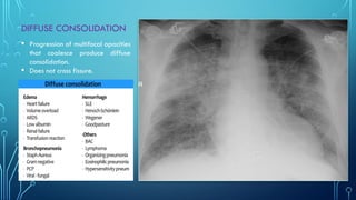 Chest xray pattern Part 1 Year 2 Class.pptx