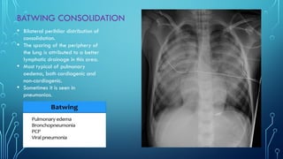 Chest xray pattern Part 1 Year 2 Class.pptx
