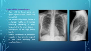 Triangular Sign Chest Chest xray pattern Part 1 Year 2 Class.pptx