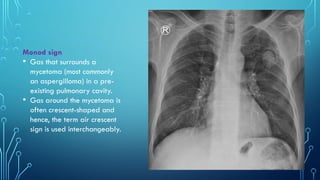 Manod Sign Chest xray pattern Part 1 Year 2 Class.pptx