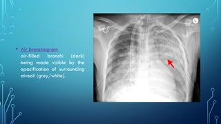 Chest xray pattern Part 1 Year 2 Class.pptx