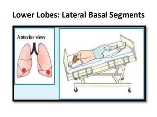 Llsb Chest physiotherapy, | PPTX