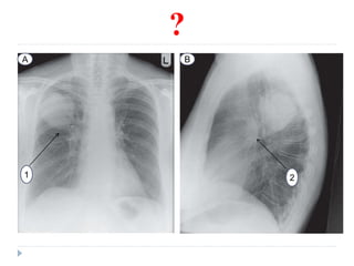 Chest radiograph | PPTX