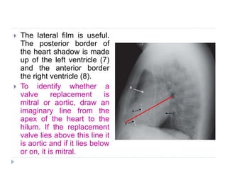 Aortic Shadow Chest radiograph | PPTX