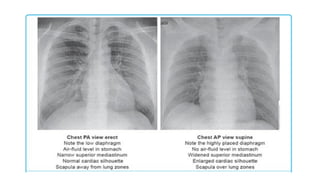 CHEST RADIOGRAPH .pptx