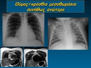 Θύμος=πρόσθιο μεσοθωράκιο
     συνήθως ανώτερο
 