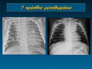 ? πρόσθιο μεσοθωράκιο
 