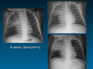 8 μηνών, βρογχιολίτις
 