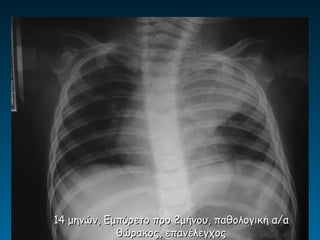 14 μηνών, Εμπύρετο προ 2μήνου, παθολογική α/α
            θώρακος, επανέλεγχος
 