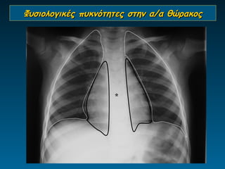 Φυσιολογικές πυκνότητες στην α/α θώρακος




                    *
 
