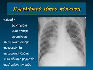Κυψελιδικού τύπου πύκνωση
•λοίμωξη
      βακτηρίδια
      μυκόπλασμα
      φυματίωση
•πνευμονικό οίδημα
•πνευμονίτιδα
•πνευμονική θλάση
•κυψελιδική αιμορραγία
•παρ’ ολίγον πνιγμός
 