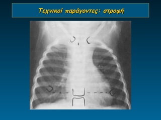 Τεχνικοί παράγοντες: στροφή
 