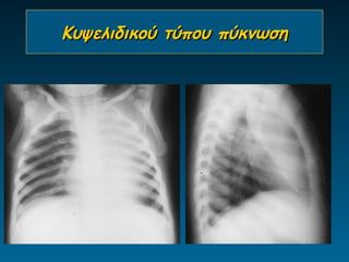 Κυψελιδικού τύπου πύκνωση
 