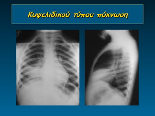 Κυψελιδικού τύπου πύκνωση
 