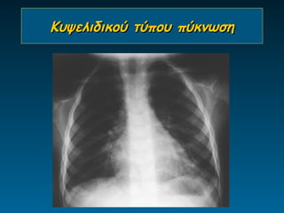 Κυψελιδικού τύπου πύκνωση
 