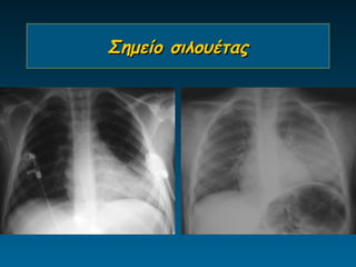 Σημείο σιλουέτας
 