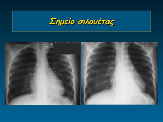 Σημείο σιλουέτας
 