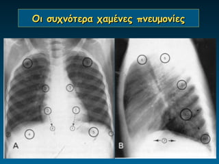 Οι συχνότερα χαμένες πνευμονίες
 