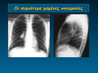 Οι συχνότερα χαμένες πνευμονίες
 