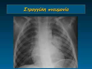 Στρογγύλη πνευμονία
 