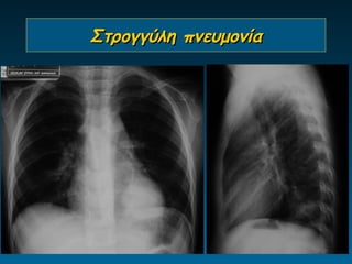 Στρογγύλη πνευμονία
 