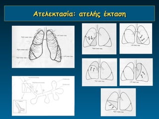 Aτελεκτασία: ατελής έκταση
 
