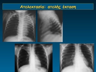 Aτελεκτασία: ατελής έκταση
 