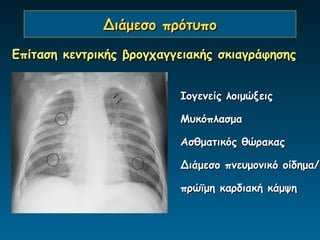 Διάμεσο πρότυπο

Επίταση κεντρικής βρογχαγγειακής σκιαγράφησης


                          Ιογενείς λοιμώξεις

                          Μυκόπλασμα

                          Ασθματικός θώρακας

                          Διάμεσο πνευμονικό οίδημα/

                          πρώϊμη καρδιακή κάμψη
 