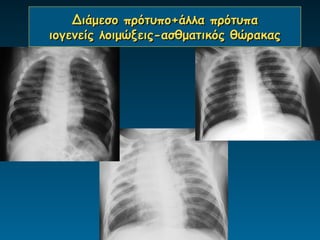 Διάμεσο πρότυπο+άλλα πρότυπα
ιογενείς λοιμώξεις-ασθματικός θώρακας
 