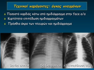 Τεχνικοί παράγοντες: όγκος πνευμόνων

ό   Ποσοστό καρδιάς κάτω από ημιδιάφραγμα στην face α/α
ό   Κυρτότητα-επιπέδωση ημιδιαφραγμάτων
ό   Πρόσθια άκρα των πλευρών και ημιδιάφραγμα




     3η-4η: εκπνοή       5η-6η: εισπνοή > 7η:παγίδευση αέρα
 