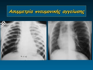 Ασυμμετρία πνευμονικής αγγείωσης
 